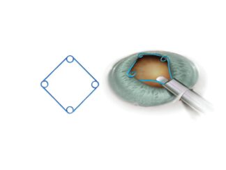 Malyugin 2.0 Ring 6.25mm Diameter